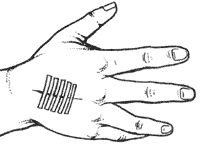 Разорванную рану можно стянуть, используя полоски лейкопластыря, как показано на рисунке.