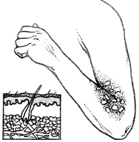 Ожог второй степени вызывает покраснение кожи с белыми участками, которые вздуваются пузырями. Обожженный участок выглядит блестящим.