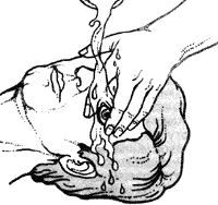 1. Лейте воду на глаз пострадавшего от внутреннего угла к внешнему в течение 10 мин.