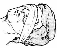 2. Тщательно промыв, наложите на глаза марлевые тампоны и перевяжите так, чтобы тампоны держались на месте.